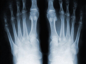 New research shows that vitamin D and calcium are good for our bones – and, on a more general level, the combination of the two reduces mortality. (Photo: Colourbox) New research shows that vitamin D and calcium are good for our bones – and, on a more general level, the combination of the two reduces mortality. (Photo: Colourbox)