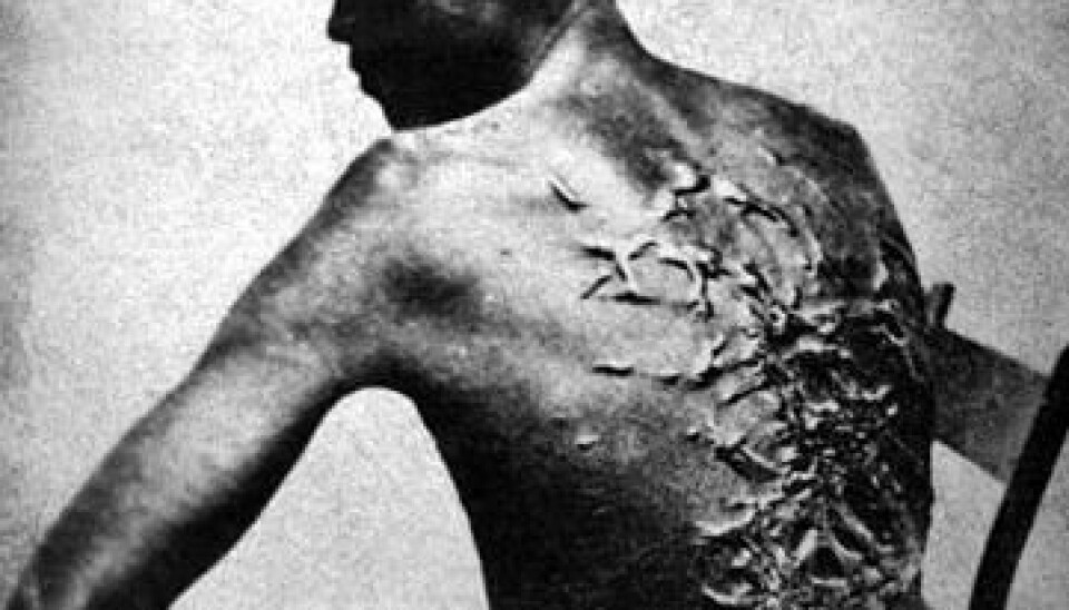Scars on a slave who was whipped. The man in the picture was called Peter and comes from Louisiana in the US – not from the Virgin Islands. But the rules and regulations regarding slavery in the Danish West Indies show that whipping and amputation of limbs were punishments that slaves in the West Indies risked facing if they attempted escape or revolt. (Photo: National Archives and Records Administration)