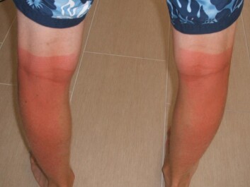 Nordic skin burns easily (Photo: Colourbox) Nordic skin burns easily (Photo: Colourbox)