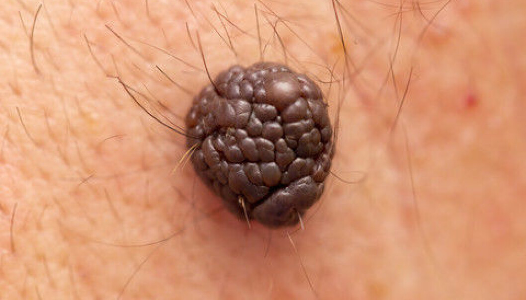 A new method for treating melanoma is showing great promise in a Danish hospital. By treating patients with their own T-cells, researchers can kick-start the patients’ immune system and make it destroy the cancer cells. (Photo: Colourbox) A new method for treating melanoma is showing great promise in a Danish hospital. By treating patients with their own T-cells, researchers can kick-start the patients’ immune system and make it destroy the cancer cells. (Photo: Colourbox)