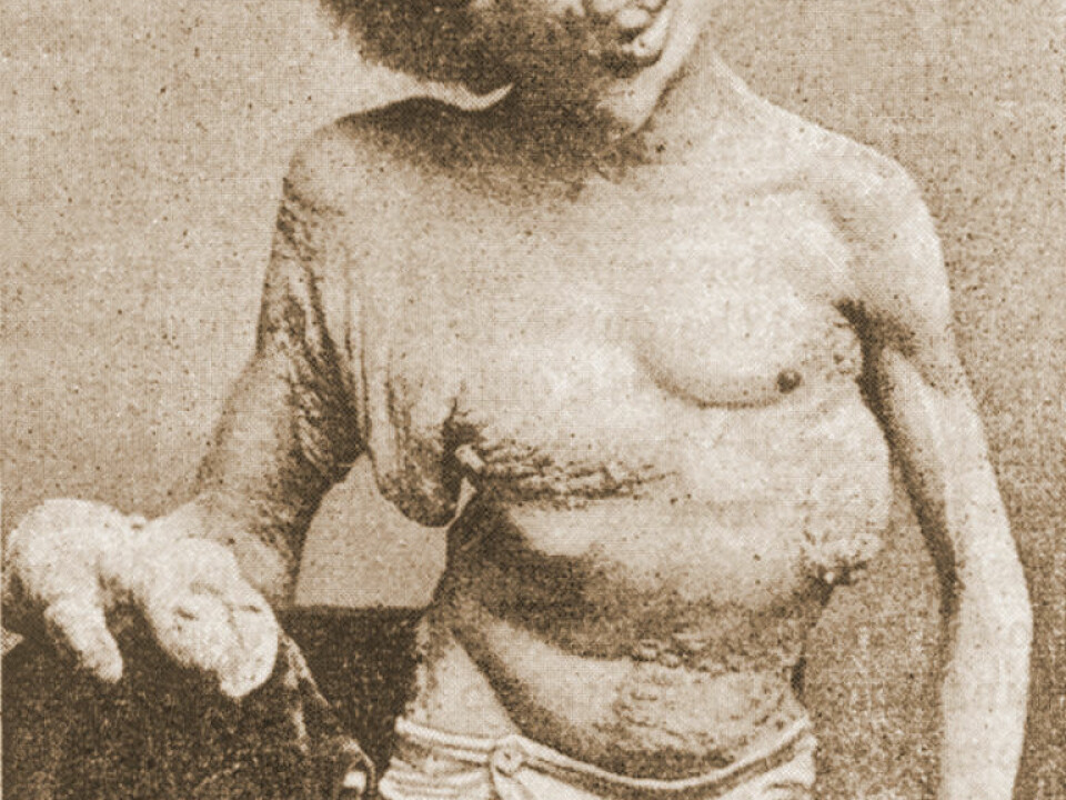 Joseph Merrick, a.k.a. the Elephant Man, photographed in 1889, a year before his death. (Photo: Wikimedia Commons, anonymous photographer)