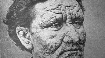 Why leprosy is still going strong