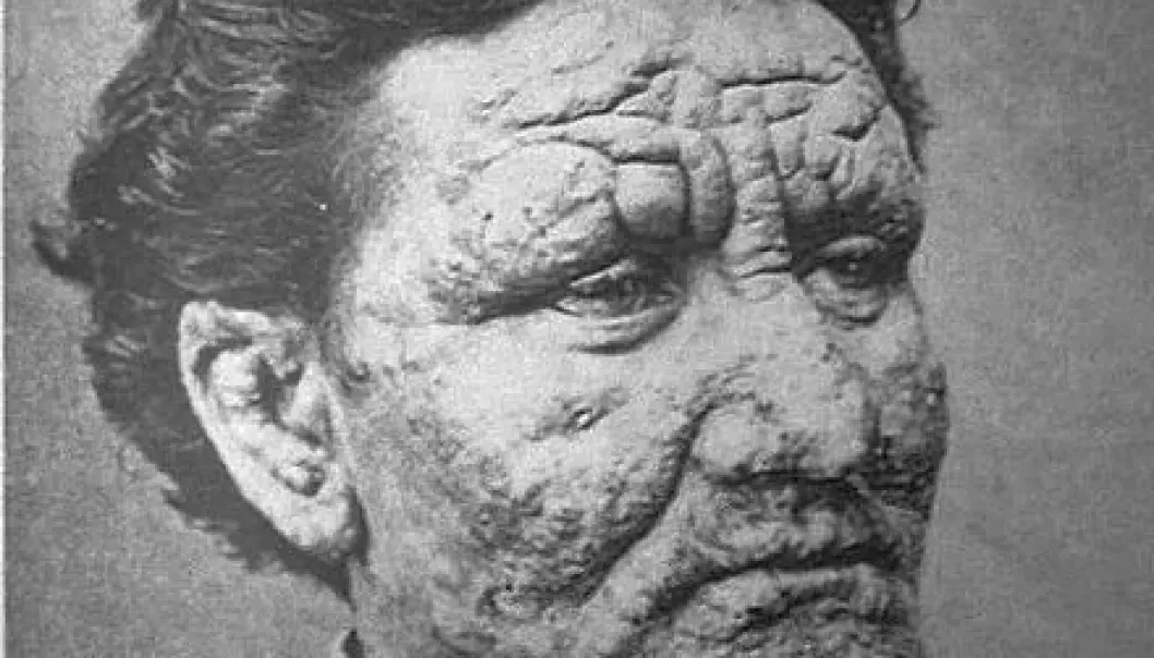 Leprosy was one of the most dreaded diseases in the Middle Ages. But the disease is still alive and kicking. The picture shows a young Norwegian man, who was infected with the disease in 1886. Now scientists have sequenced the genome of the bacterium that causes leprosy. (Photo: Wikimedia Commons)