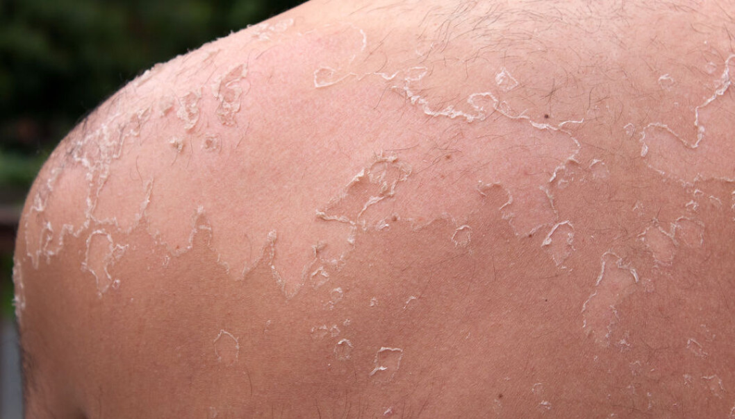 Too much sun exposure may cause the skin condition actinic keratosis, which can be a precursor to skin cancer. A Danish pharmaceutical company has developed a gel that contains the substance Ingenol Mebutate, which can treat the condition in only two or three days. (Photo: Shutterstock) Too much sun exposure may cause the skin condition actinic keratosis, which can be a precursor to skin cancer. A Danish pharmaceutical company has developed a gel that contains the substance Ingenol Mebutate, which can treat the condition in only two or three days. (Photo: Shutterstock)