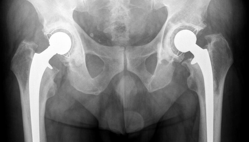 An X-ray photograph of an elderly man’s hip prostheses. (Photo: Colourbox)