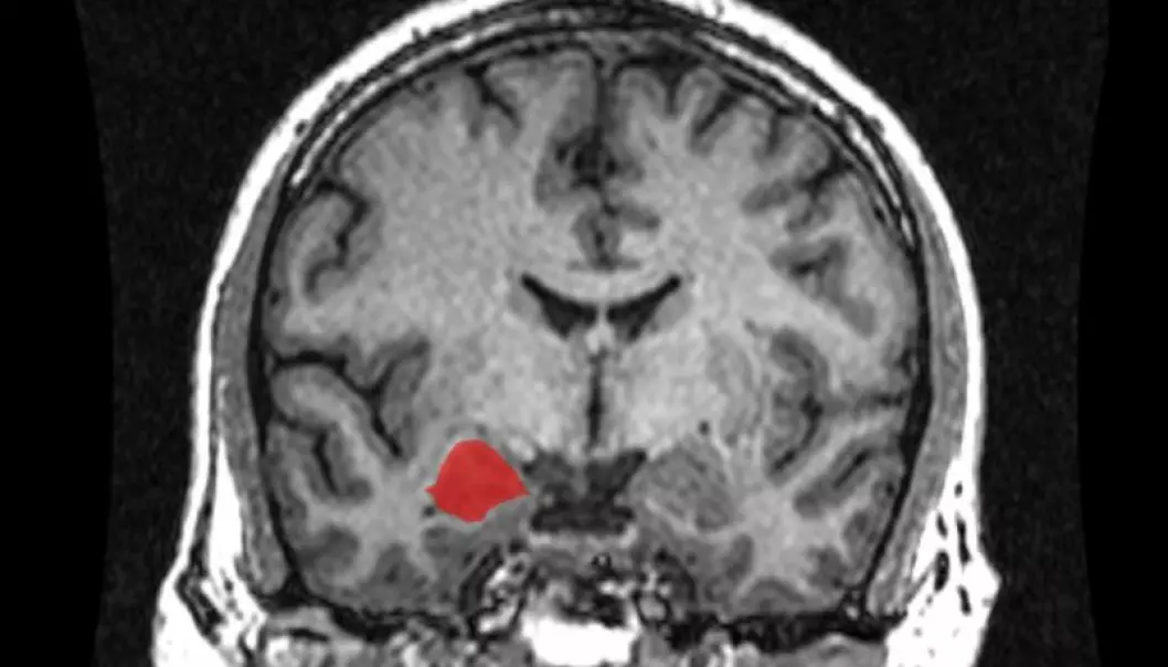 The amygdala (red region), as seen in a Magnetic Resonance Imaging scan taken from behind. (Photo: Amber Rieder, Jenna Traynor, Geoffrey B Hall, Creative Commons)