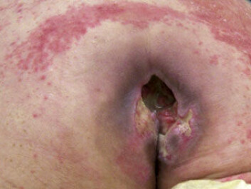 A pressure ulcer usually starts under the buttocks. The new study seeks to find out why this is so, as this would enable researchers to develop guidelines and products that can minimise the risk of developing pressure ulcers. (Photo: Wikimedia Commons) A pressure ulcer usually starts under the buttocks. The new study seeks to find out why this is so, as this would enable researchers to develop guidelines and products that can minimise the risk of developing pressure ulcers. (Photo: Wikimedia Commons)