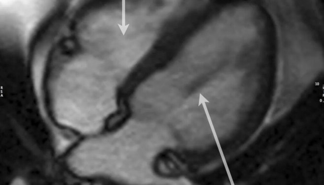 MRI scan of a heart, with all four chambers visible. (Photo: Copenhagen University Hospital) MRI scan of a heart, with all four chambers visible. (Photo: Copenhagen University Hospital)