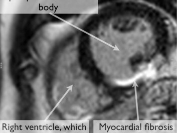 MRI scan of the heart after contrast injection, with visible scar tissue. This is a case of fibrosis following a heart attack (Photo: Copenhagen University Hospital)