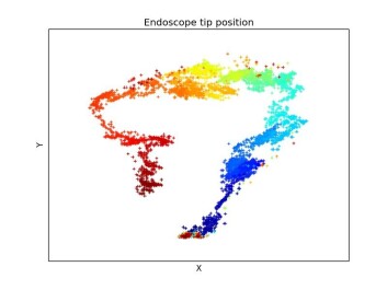 During a scan, the new system draws a picture which shows where in the intestine the colonoscope slowed down or got stuck. The greater the density of the dots, the longer the colonoscope stayed in one place. (Photo: Simonsen and Weel) During a scan, the new system draws a picture which shows where in the intestine the colonoscope slowed down or got stuck. The greater the density of the dots, the longer the colonoscope stayed in one place. (Photo: Simonsen and Weel)