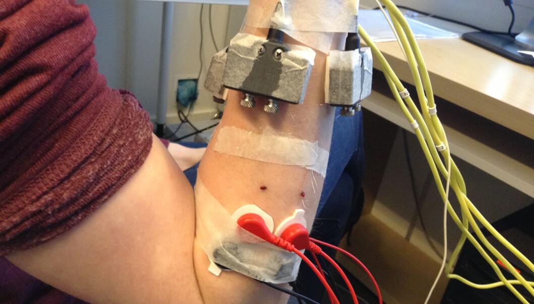 The electrodes with the red wires are surface electrodes that measure signals from the muscles. These are nowhere near as effective as the two electrodes that have been implanted in the two holes just above the red wires. These are linked directly to the muscle and are thus much better at detecting signals. (Photo: Ernest Kamavuako) The electrodes with the red wires are surface electrodes that measure signals from the muscles. These are nowhere near as effective as the two electrodes that have been implanted in the two holes just above the red wires. These are linked directly to the muscle and are thus much better at detecting signals. (Photo: Ernest Kamavuako)