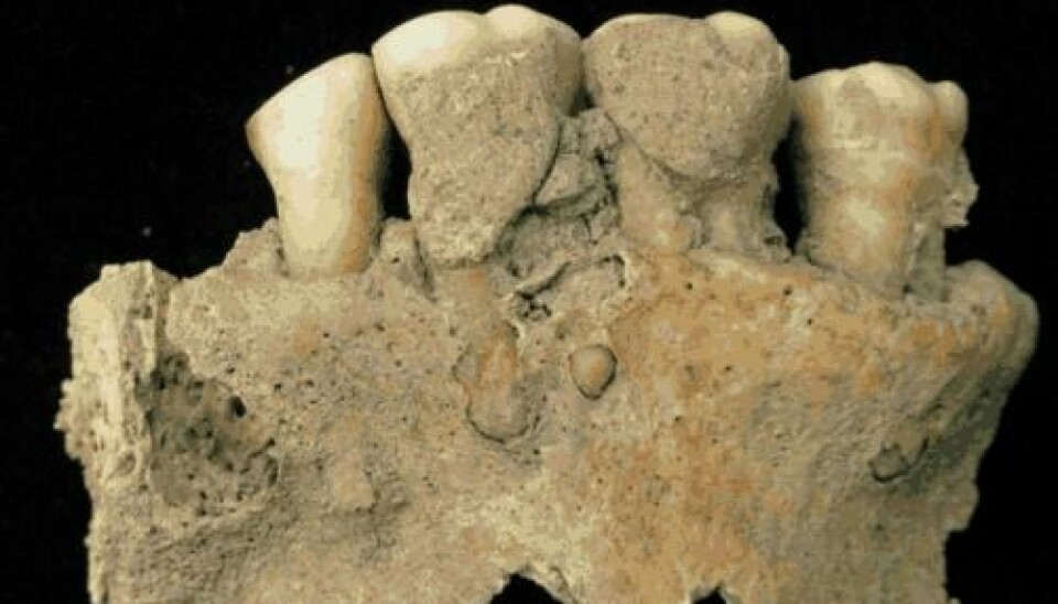Three molars and a premolar from an ancient German monk. (Photo: Christina Warinner)