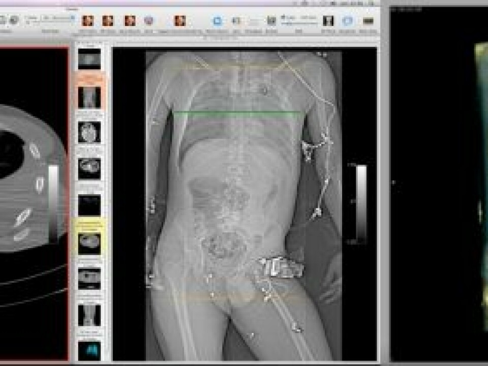 A CT scan of a gunshot victim. The green arrow marks the entry wound. The three-dimensional sample shows the bullet’s trajectory.