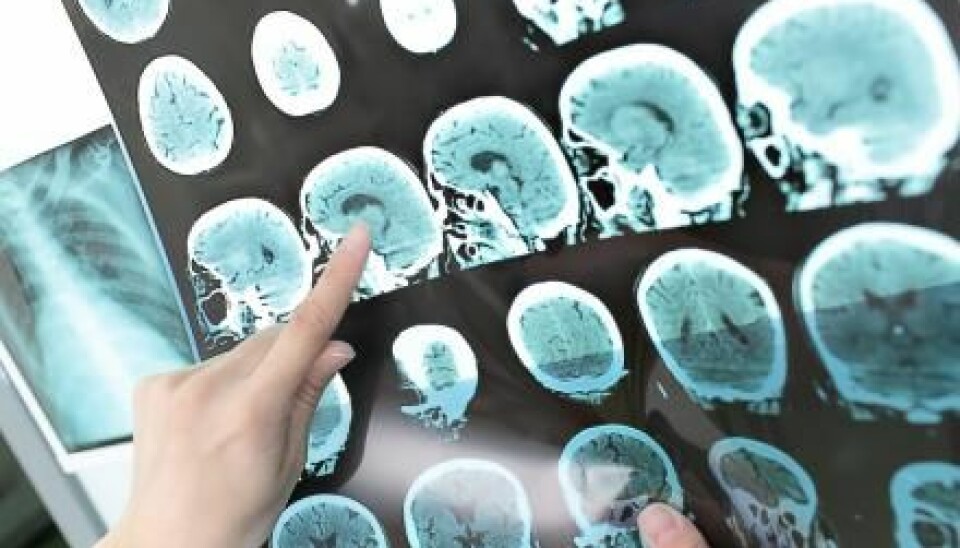Danish scientists will be the first in the world to try to help MS patients by transplanting stem cells into the damaged areas of the brain. (Photo: Shutterstock)