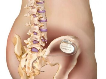 In sacral nerve stimulation therapy, a small electrical device that sends small bursts of electricity is implanted into the patient's sacral nerves. (Photo: Medtronic/Lilli Lundby ) In sacral nerve stimulation therapy, a small electrical device that sends small bursts of electricity is implanted into the patient's sacral nerves. (Photo: Medtronic/Lilli Lundby )