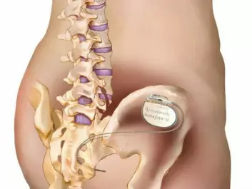 In sacral nerve stimulation therapy, a small electrical device that sends small bursts of electricity is implanted into the patient's sacral nerves. (Photo: Medtronic/Lilli Lundby )