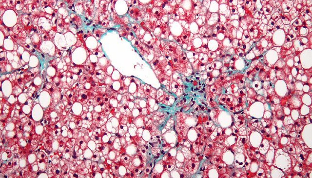 The image shows a microscope photo of a non-alcoholic fatty liver. The liver has a very prominent occurrence of fat in the cells (the white spots) and fibrosis (green areas). The red parts of the image are the liver’s own cells. The amount of fat in the liver is so large that it distorts the cell nucleus. (Photo: Nephron) The image shows a microscope photo of a non-alcoholic fatty liver. The liver has a very prominent occurrence of fat in the cells (the white spots) and fibrosis (green areas). The red parts of the image are the liver’s own cells. The amount of fat in the liver is so large that it distorts the cell nucleus. (Photo: Nephron)
