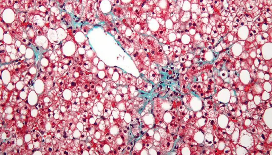 The image shows a microscope photo of a non-alcoholic fatty liver. The liver has a very prominent occurrence of fat in the cells (the white spots) and fibrosis (green areas). The red parts of the image are the liver’s own cells. The amount of fat in the liver is so large that it distorts the cell nucleus. (Photo: Nephron)