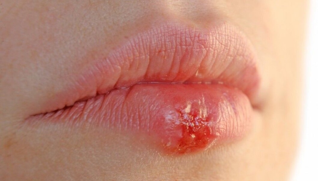 The herpes virus is a common infection, but it can have serious consequences with age. (Photo: Colourbox) The herpes virus is a common infection, but it can have serious consequences with age. (Photo: Colourbox)