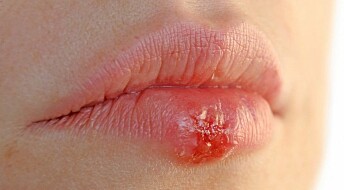 Cold sores linked to dementia