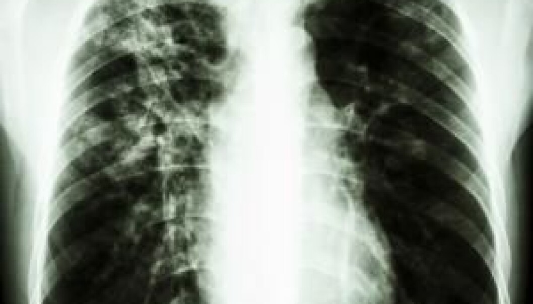 Tuberculosis is highly contagious and often attacks the lungs. (Photo: <a href="http://www.shutterstock.com/da/pic-182979407/stock-photo-film-chest-x-ray-pa-upright-show-interstitial-infiltration-at-right-lung-due-to-mycobacterium.html?src=csl_recent_image-1&ws=1" target="_blank">Shutterstock</a>) Tuberculosis is highly contagious and often attacks the lungs. (Photo: <a href="http://www.shutterstock.com/da/pic-182979407/stock-photo-film-chest-x-ray-pa-upright-show-interstitial-infiltration-at-right-lung-due-to-mycobacterium.html?src=csl_recent_image-1&ws=1" target="_blank">Shutterstock</a>)