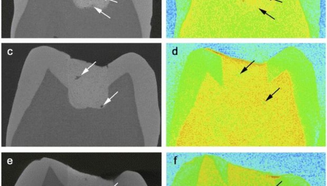 On the left are X-ray images of teeth with fillings of glasionome cement. The pictures show the porosity of the cement. On the right are images of the same teeth with neutron spreading, which shows if the pores are full of fluid. (Photo: Benetti, A.R. et al., Scientific Reports) On the left are X-ray images of teeth with fillings of glasionome cement. The pictures show the porosity of the cement. On the right are images of the same teeth with neutron spreading, which shows if the pores are full of fluid. (Photo: Benetti, A.R. et al., Scientific Reports)