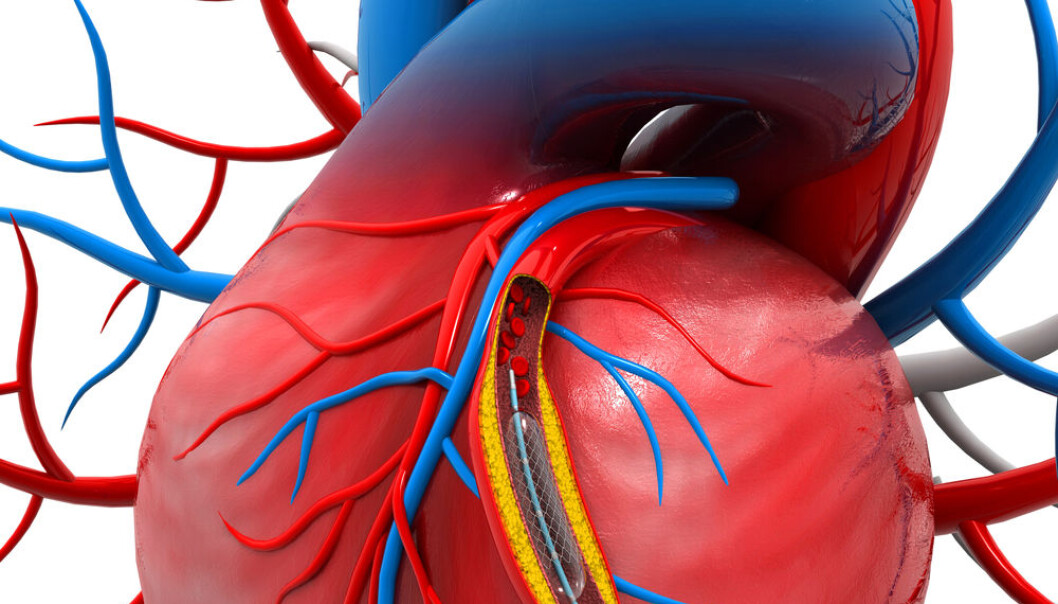 The study showed that the subsequent risk dying, having a new coronary thrombosis or requiring angioplasty fell by 44 per cent if the patient had all blood vessel constrictions treated. (Photo: <a href="http://www.shutterstock.com/pic-223202266/stock-photo-stent-angioplasty-procedure-with-placing-a-balloon.html" target"_Blank">Shutterstock</a>) The study showed that the subsequent risk dying, having a new coronary thrombosis or requiring angioplasty fell by 44 per cent if the patient had all blood vessel constrictions treated. (Photo: <a href="http://www.shutterstock.com/pic-223202266/stock-photo-stent-angioplasty-procedure-with-placing-a-balloon.html" target"_Blank">Shutterstock</a>)