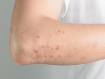Allergies can manifest themselves in many different ways, for example, as a rash. (Photo: Shutterstock) Allergies can manifest themselves in many different ways, for example, as a rash. (Photo: Shutterstock)