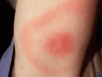 In most cases Borrelia infections leave a red rash on the skin, marking the tick bite. But this is not the case with Borrelia miyamotoi, which leaves no rash. (Photo: CDC/James Gathany)