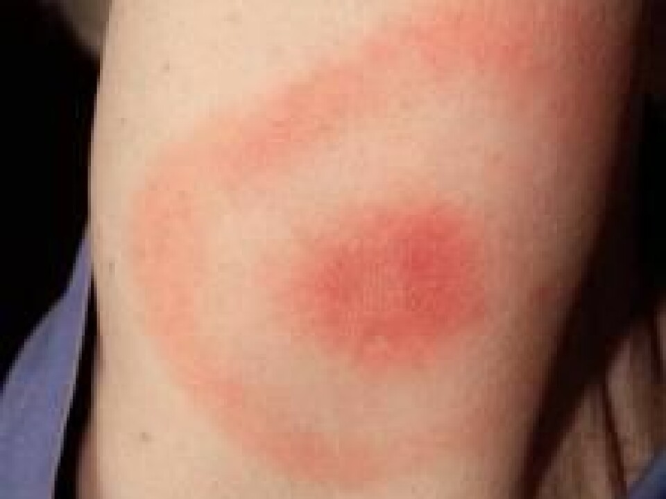 In most cases Borrelia infections leave a red rash on the skin, marking the tick bite. But this is not the case with Borrelia miyamotoi, which leaves no rash. (Photo: CDC/James Gathany)