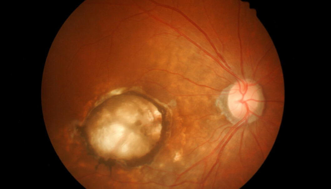 A severe eye disease, common amongst diabetics, causes blood vessels in the eye to grow and spread. Eventually, holes form in some of the blood vessels causing blood to flow into the eye, which leads to blindness. (Photo: Shutterstock) A severe eye disease, common amongst diabetics, causes blood vessels in the eye to grow and spread. Eventually, holes form in some of the blood vessels causing blood to flow into the eye, which leads to blindness. (Photo: Shutterstock)