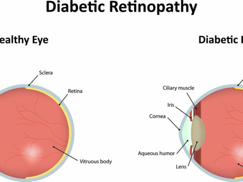 Illustration of the differences between a healthy eye and one damaged by diabeties. (Photo: Shutterstock)