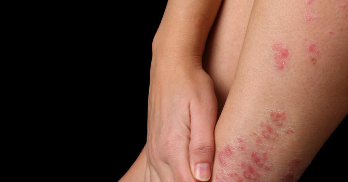 psoriasis and crohns disease