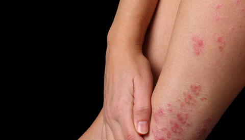 psoriasis and crohn's)