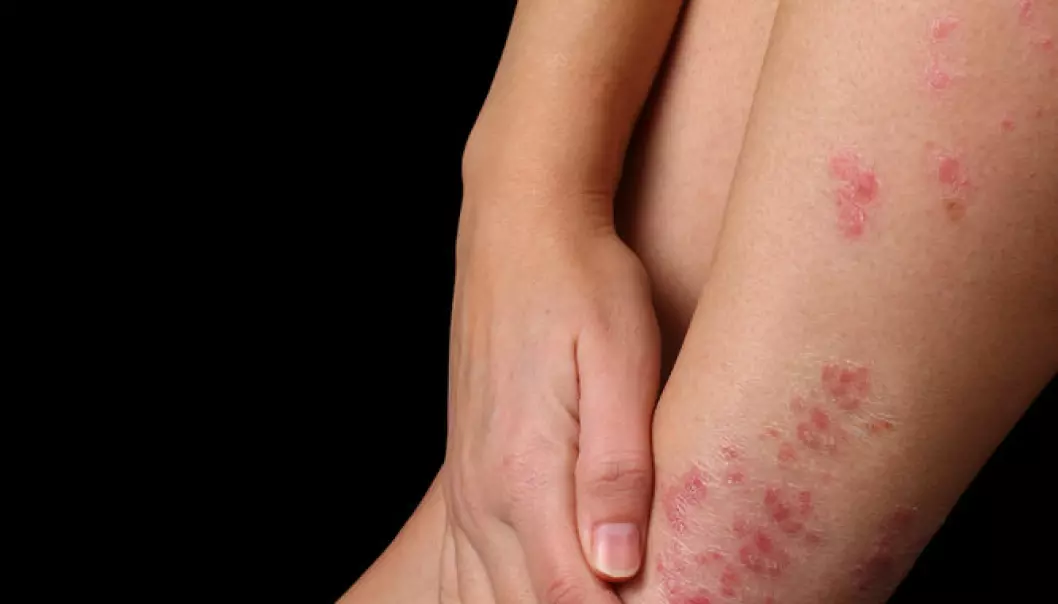 Researchers have found that eczema and a variety of other common diseases are caused by the same genetic variants. (Photo: Shutterstock)