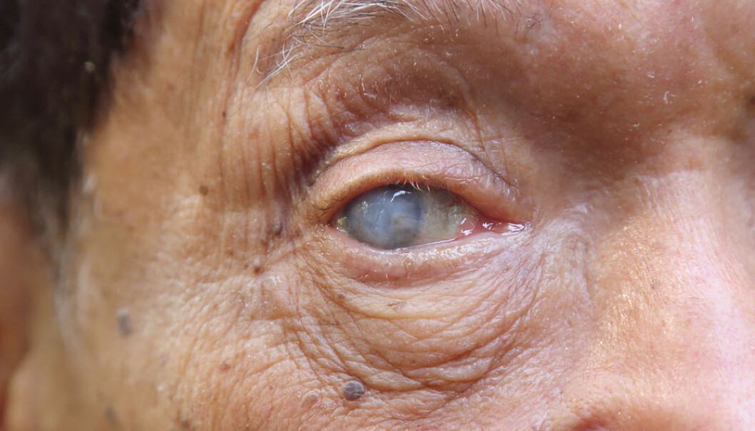 Nearly twice as many blind people suffer from seasonally effective disorder (SAD) compared to people with normal vision. But those with poor vision suffer the most, concludes a new study. (Photo: Shutterstock) Nearly twice as many blind people suffer from seasonally effective disorder (SAD) compared to people with normal vision. But those with poor vision suffer the most, concludes a new study. (Photo: Shutterstock)