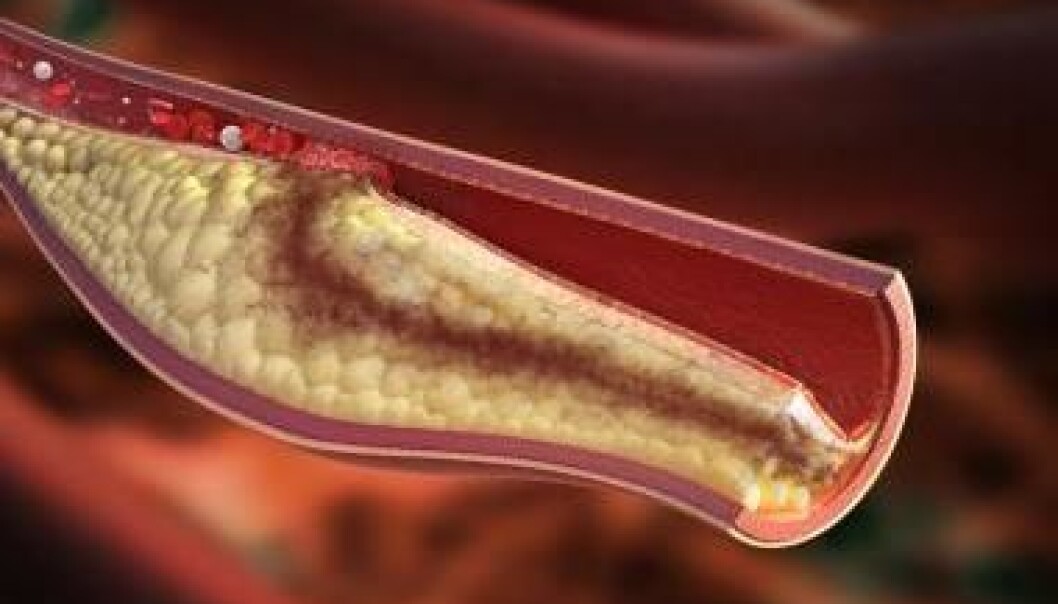 Atherosclerosis is an inflammatory condition which occurs when the cholesterol and fat adheres to the walls of arteries, hardening them. But cyclodextrin might be an effective treatment, shows new research. (Photo: <a href=http://www.shutterstock.com/da/pic-181080389/stock-photo-atherosclerotic-plaque-development-high-detail-image-of-unstable-atherosclerotic-plaque-condition.html target="_blank">Shutterstock</a>)
Atherosclerosis is an inflammatory condition which occurs when the cholesterol and fat adheres to the walls of arteries, hardening them. But cyclodextrin might be an effective treatment, shows new research. (Photo: <a href=http://www.shutterstock.com/da/pic-181080389/stock-photo-atherosclerotic-plaque-development-high-detail-image-of-unstable-atherosclerotic-plaque-condition.html target="_blank">Shutterstock</a>)