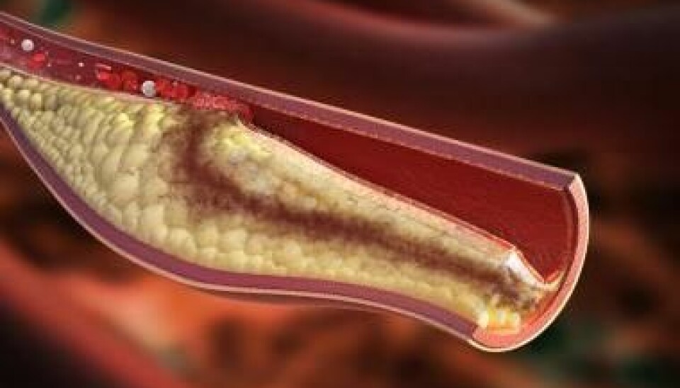 Atherosclerosis is an inflammatory condition which occurs when the cholesterol and fat adheres to the walls of arteries, hardening them. But cyclodextrin might be an effective treatment, shows new research. (Photo: Shutterstock)
