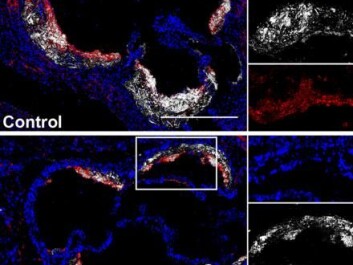 Treatment with CD reduced the number of cholesterol crystals in atherosclerosis affected areas in mice. Here you can see a microscope image of the control group (top) and the CD-treated mice (bottom). Damaging cholesterol crystals are shown in white. (Photo: Zimmer et al., Science Translational Medicine (2016)) Treatment with CD reduced the number of cholesterol crystals in atherosclerosis affected areas in mice. Here you can see a microscope image of the control group (top) and the CD-treated mice (bottom). Damaging cholesterol crystals are shown in white. (Photo: Zimmer et al., Science Translational Medicine (2016))