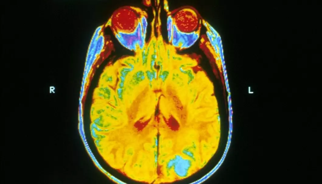 The blue regions of this magnetic resonance imaging (MRI) brain scan indicate cancer.  (Photo: National Cancer Institute/Wikimedia)
