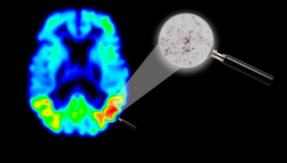 Swedish researchers have conducted an autopsy of the brain of a man who before death had received a tau-PET scan. This showed them that the images of concentrations of the protein tau made when he was alive corresponded to actual concentrations in his brain tissue. The red colour in the image above gives a clear indication of where the tau protein is accumulating in the brain. Next to this is a microscope image of the brain area in question. The dark red threads are tau proteins. (Illustration: Michael Schöll, Lund University)