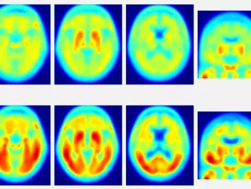PET scans showing tau deposits in the brains of healthy people (top) and patients with Alzheimer’s (bottom). The red areas indicate tau deposits. These images were released by researchers studying dementia at Washington University in St. Louis, Missouri earlier this year. In the American study it was found that the more tau protein seen in these scans, the greater these persons’ problems answering questions in a number of memory and attention tests. (Image: Dr. Matthew Brier)