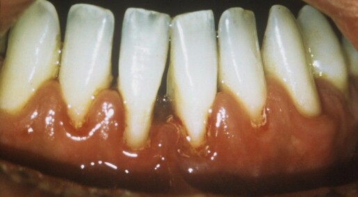Lactic acid bacteria combat a common dental disease