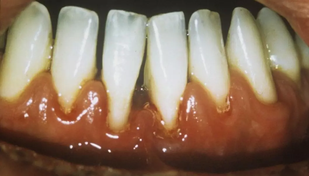 Periodontitis destroys the tissue around the teeth, both beside a tooth and beneath it. Here the deteriorated gum has pulled back, creating a gap between the teeth. (Photo: Science Photo Library)