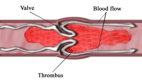 Stopping treatment with blood-thinning drug can be fatal Stopping treatment with blood-thinning drug can be fatal