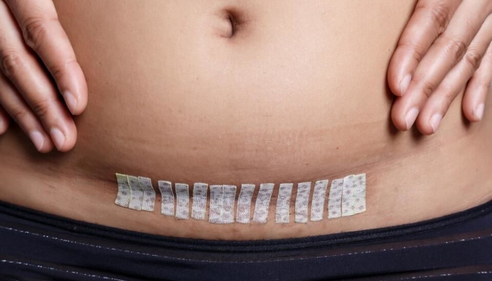 The risk of complications during a hysterectomy increase if you have previously had a C-section. (Photo: Shutterstock)
