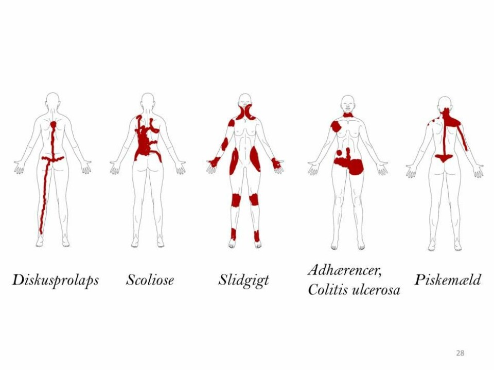 How pain looks according to one body diagram from CNAP. (Photo: Shellie A. Bourdreau)
