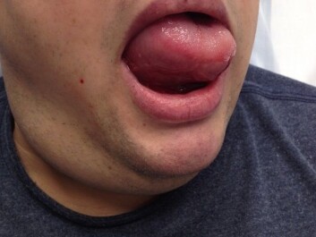 The swellings of the mouth, tongue and throat, is the result of a popular type of high blood pressure medication. Researchers have identified factors that increase the risk of developing dangerous swellings like this. (Photo: Author provided with written consent obtained from the patient.) The swellings of the mouth, tongue and throat, is the result of a popular type of high blood pressure medication. Researchers have identified factors that increase the risk of developing dangerous swellings like this. (Photo: Author provided with written consent obtained from the patient.)