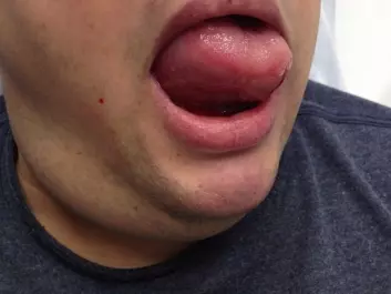 The swellings of the mouth, tongue and throat, is the result of a popular type of high blood pressure medication. Researchers have identified factors that increase the risk of developing dangerous swellings like this. (Photo: Author provided with written consent obtained from the patient.)