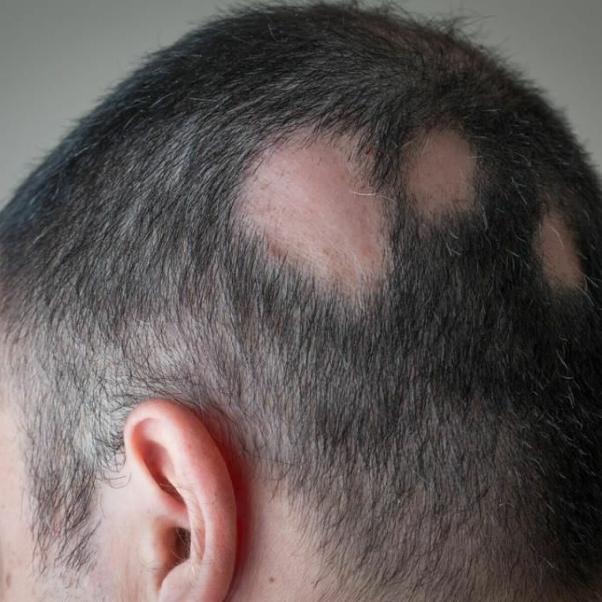 Pattern hair loss could be due to gut bacteria